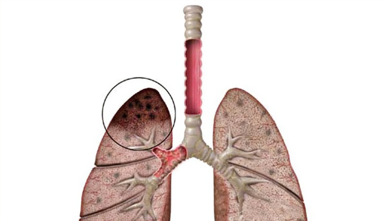 肺結(jié)核篩查做什么檢查？